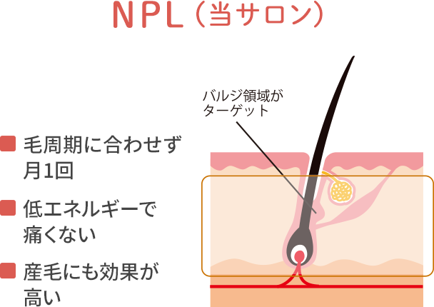 NPL（当サロン）　・毛周期に合わせず月1回　・低エネルギーで痛くない　・産毛にも効果が高い